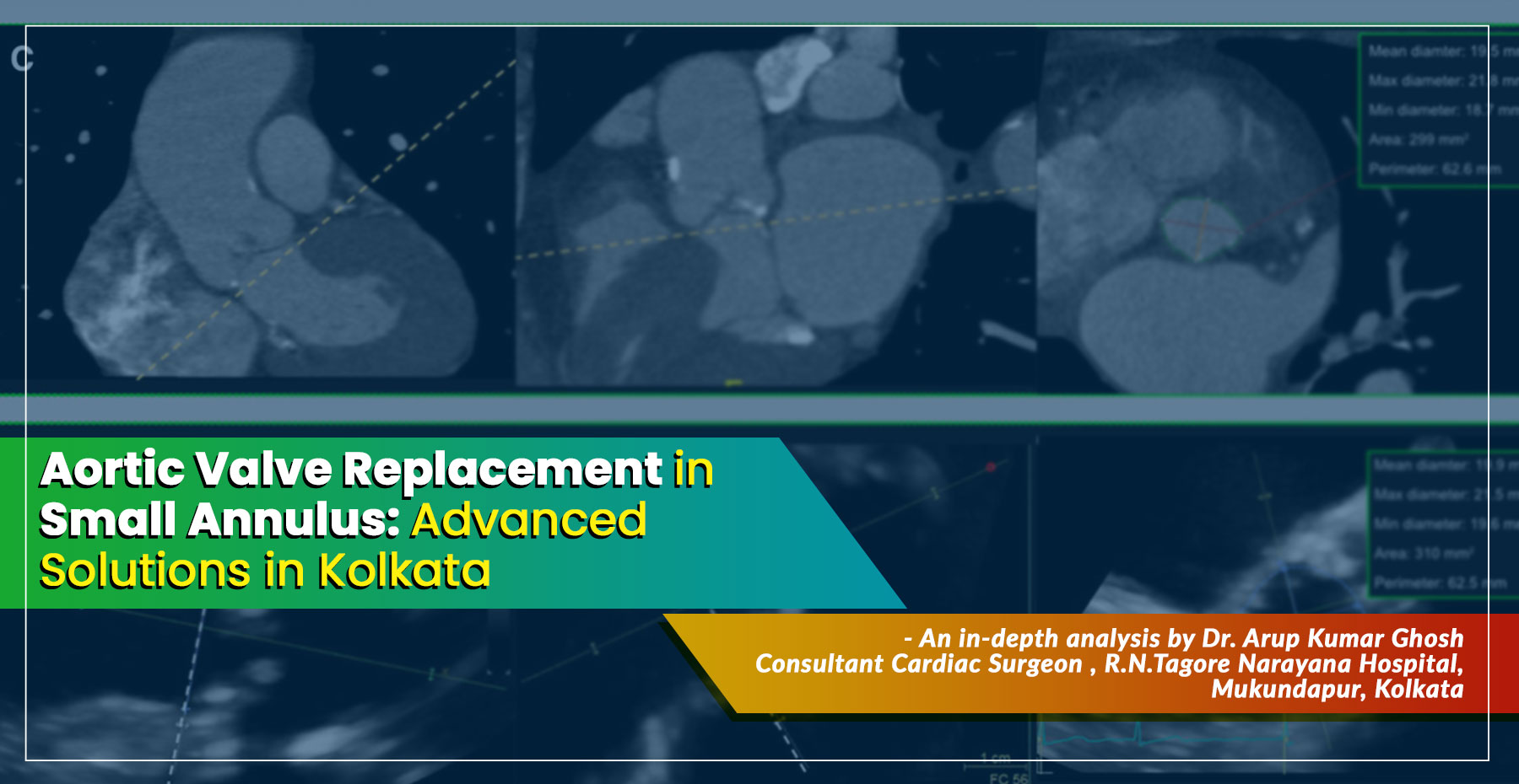 ‘Aortic Valve Replacement in Small Annulus in 2025: Advanced Solutions in Kolkata' – A Simple Guide by Dr. Arup Kumar Ghosh, Consultant Cardiac Surgeon in Kolkata, India.