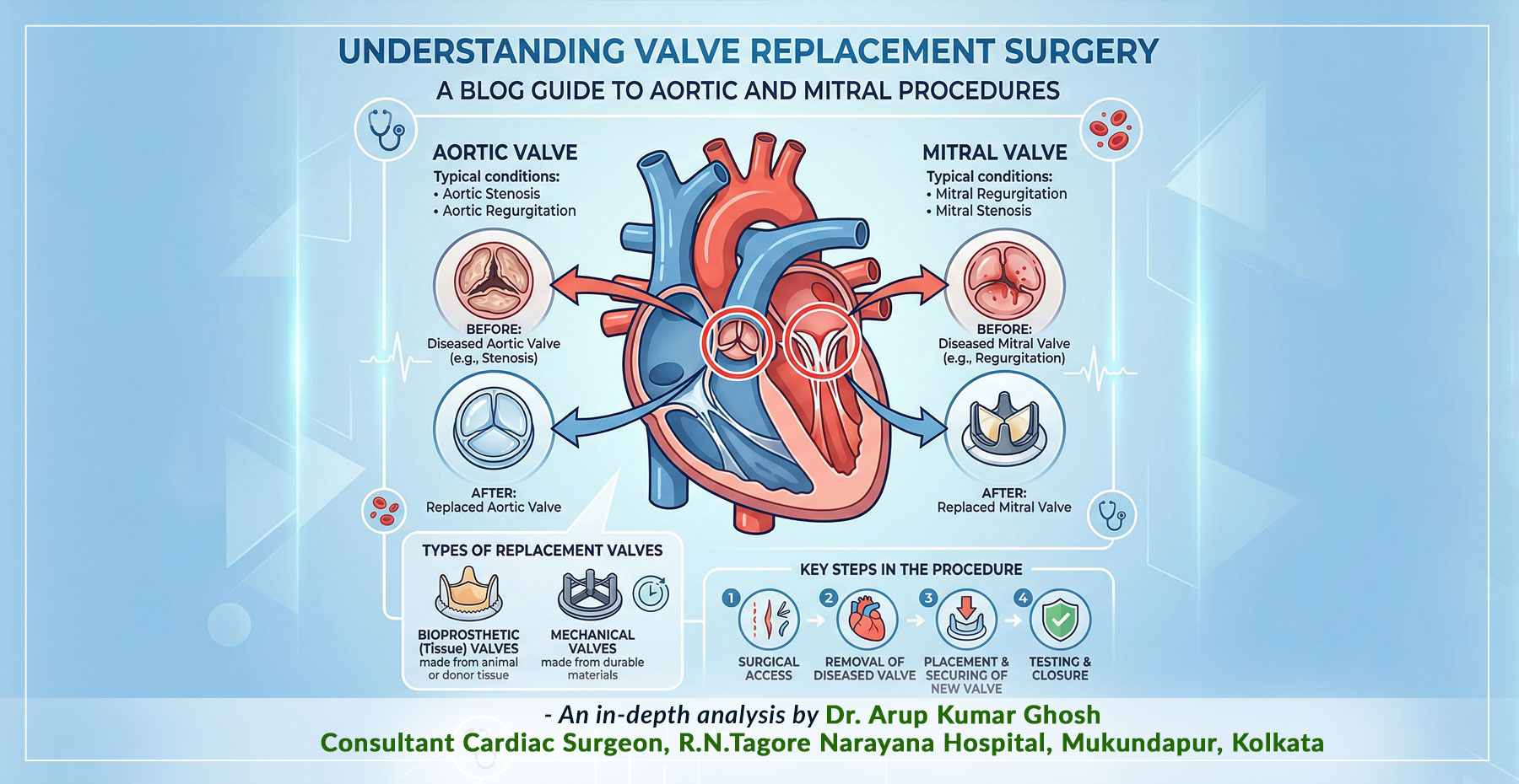 “Patient Guide to Valve Replacement Surgery in Kolkata” – An essential guide from Dr. Arup Kumar Ghosh, Renowned Cardiac Surgeon in Narayana Hospital, Kolkata